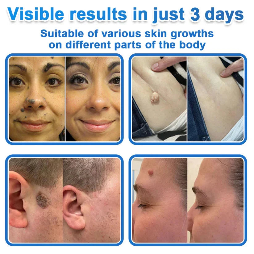 💎veyrabare® 2026 Newly Upgraded 2-in-1 Microneedle Hydrocolloid Patches | Removes Raised Moles, Acne, Flat Warts, and Skin Tags | Improves Wrinkles, Scars, and Blemishes | Invisible Acne Patches for Face & Body