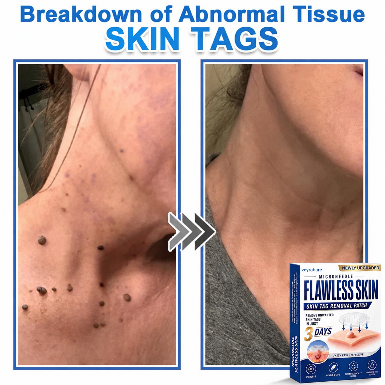 💎veyrabare® 2026 Newly Upgraded 2-in-1 Microneedle Hydrocolloid Patches | Removes Raised Moles, Acne, Flat Warts, and Skin Tags | Improves Wrinkles, Scars, and Blemishes | Invisible Acne Patches for Face & Body