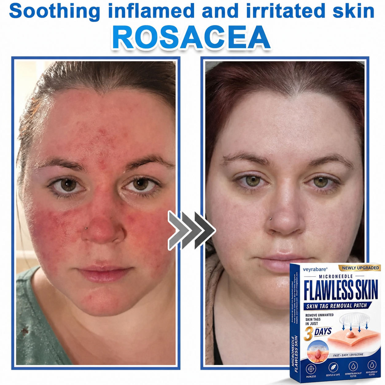 💎veyrabare® 2026 Newly Upgraded 2-in-1 Microneedle Hydrocolloid Patches | Removes Raised Moles, Acne, Flat Warts, and Skin Tags | Improves Wrinkles, Scars, and Blemishes | Invisible Acne Patches for Face & Body