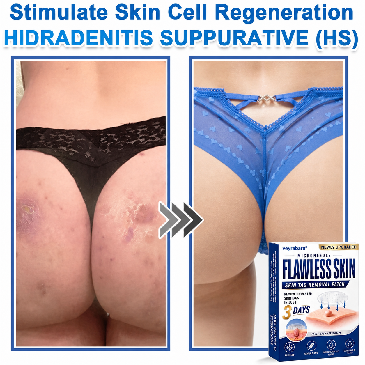💎veyrabare® 2026 Newly Upgraded 2-in-1 Microneedle Hydrocolloid Patches | Removes Raised Moles, Acne, Flat Warts, and Skin Tags | Improves Wrinkles, Scars, and Blemishes | Invisible Acne Patches for Face & Body