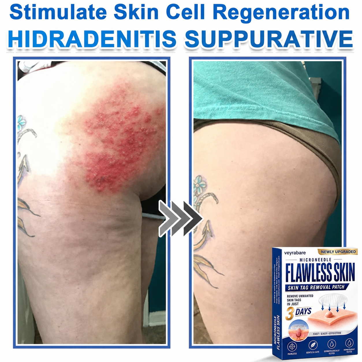 💎veyrabare® 2026 Newly Upgraded 2-in-1 Microneedle Hydrocolloid Patches | Removes Raised Moles, Acne, Flat Warts, and Skin Tags | Improves Wrinkles, Scars, and Blemishes | Invisible Acne Patches for Face & Body
